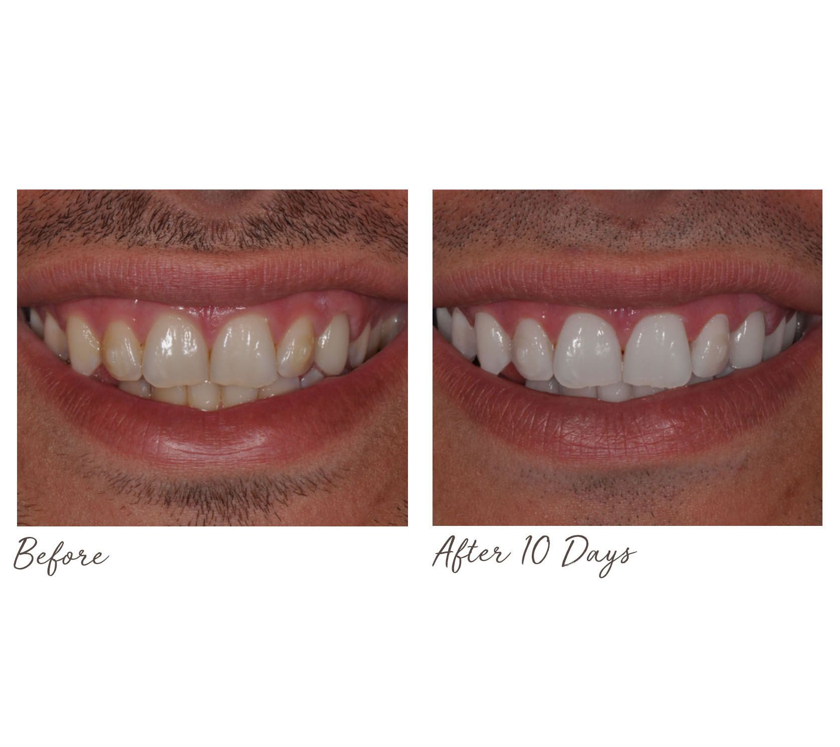 Qvc teeth whitening