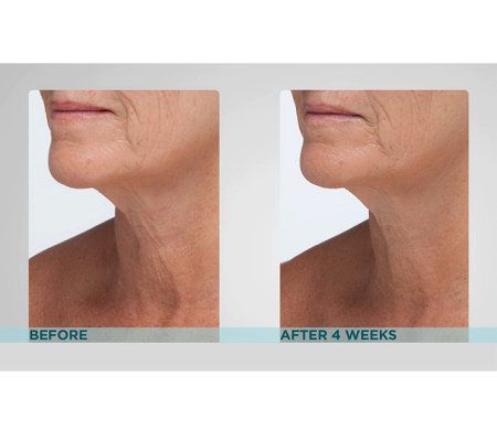 strivectin neck cream before and after photos