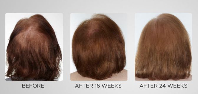 Keranique 5-Piece 60-Day Regrowth and Styling Kit — QVC.com